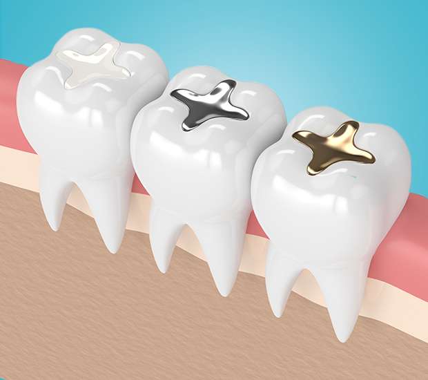 Lewisville Composite Fillings