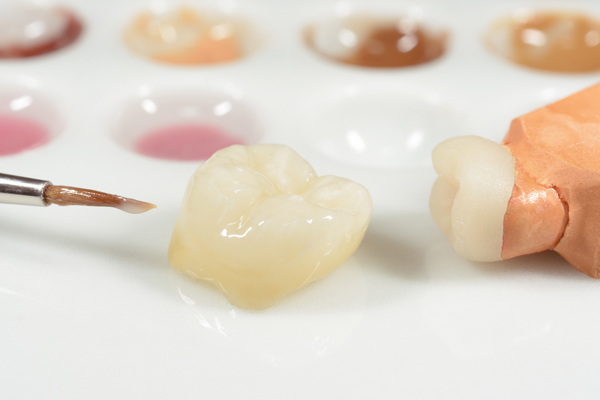 Dental Crowns Vs Bridges: Important Differences To Keep In Mind