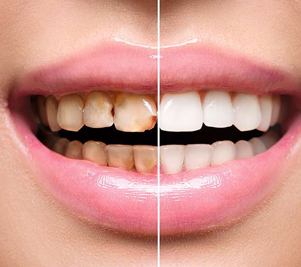 Lewisville Dental Implant Restoration