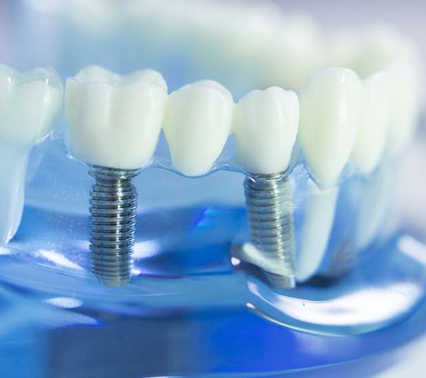 Lewisville Dental Implants