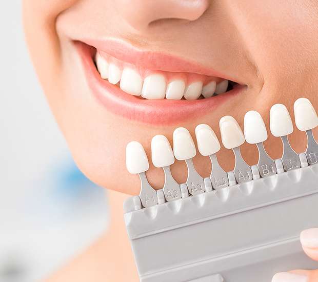 Lewisville Dental Veneers and Dental Laminates