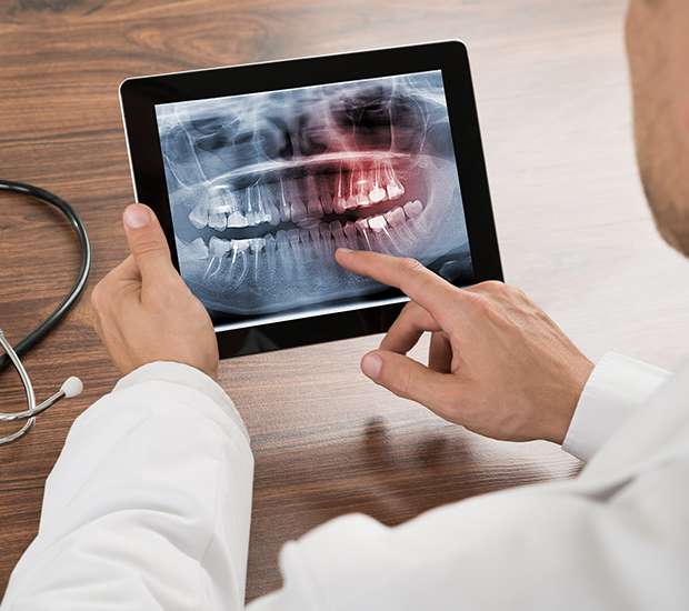 Lewisville Types of Dental Root Fractures